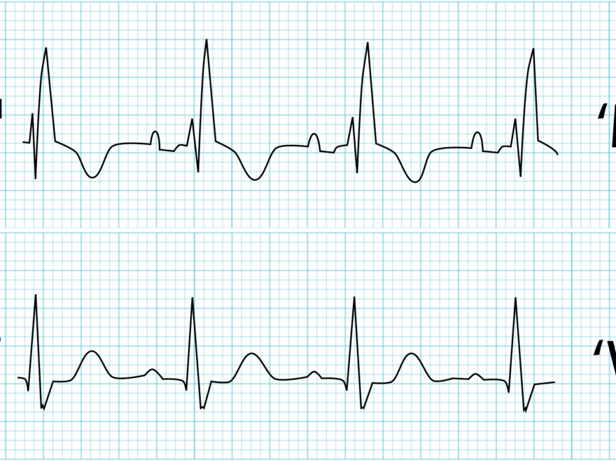 incomplete right bundle branch block symptoms