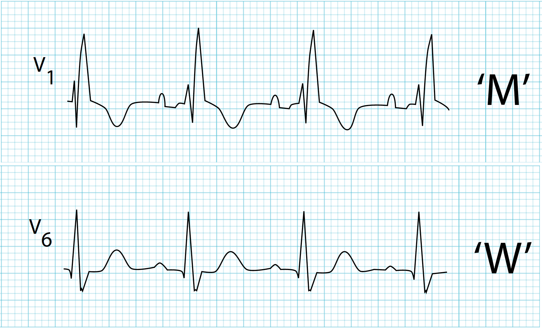 incomplete right bundle branch block symptoms