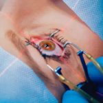 Everything You Need To Know About Laser Eye Surgery And Its Benefits