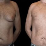 Before and After Male Breast Reduction Results