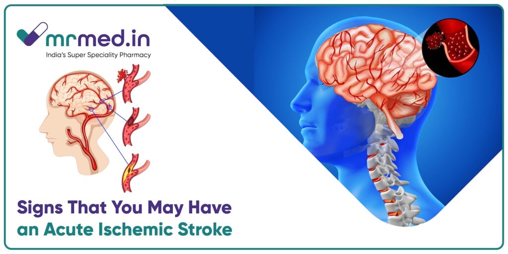 Common Warning Signs Of An Acute Ischemic Stroke You Should Never Ignore