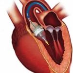 Transcatheter Heart Valve Replacement Market Analysis And Growth Forecast 2024-2032