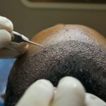 hair transplant costs