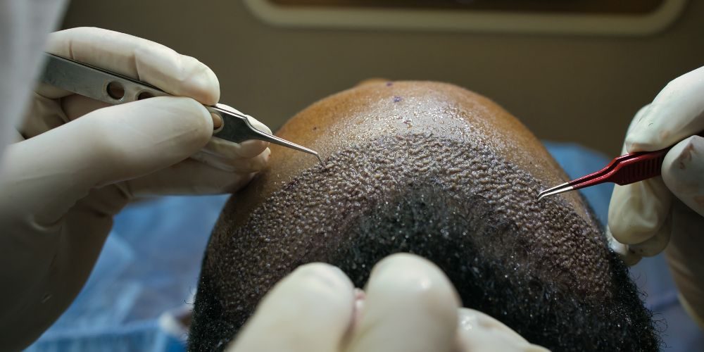 hair transplant costs