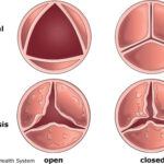 Heart valve disease treatment at IMC hospital