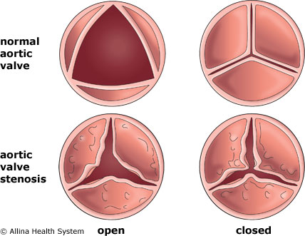 Heart valve disease treatment at IMC hospital