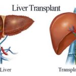 liver transplant