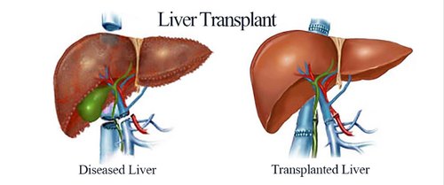 liver transplant