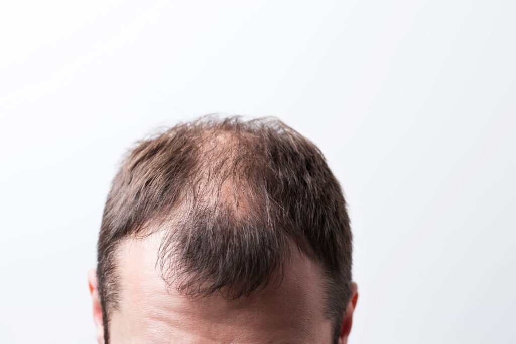 Rediscover Confidence with Scalp Micropigmentation for Alopecia