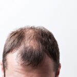 Rediscover Confidence with Scalp Micropigmentation for Alopecia