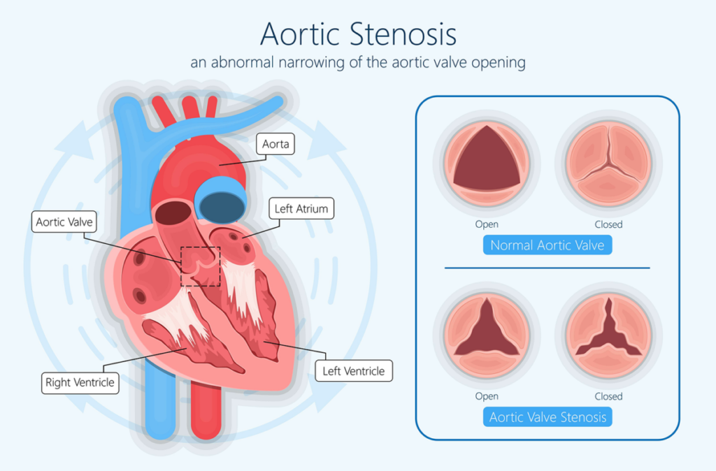 Aortic Stenosis