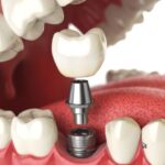 Are You a Candidate for Dental Implants? A Dentist's Guide