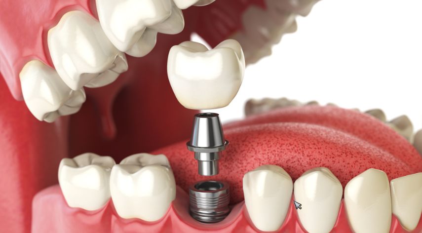 Are You a Candidate for Dental Implants? A Dentist's Guide