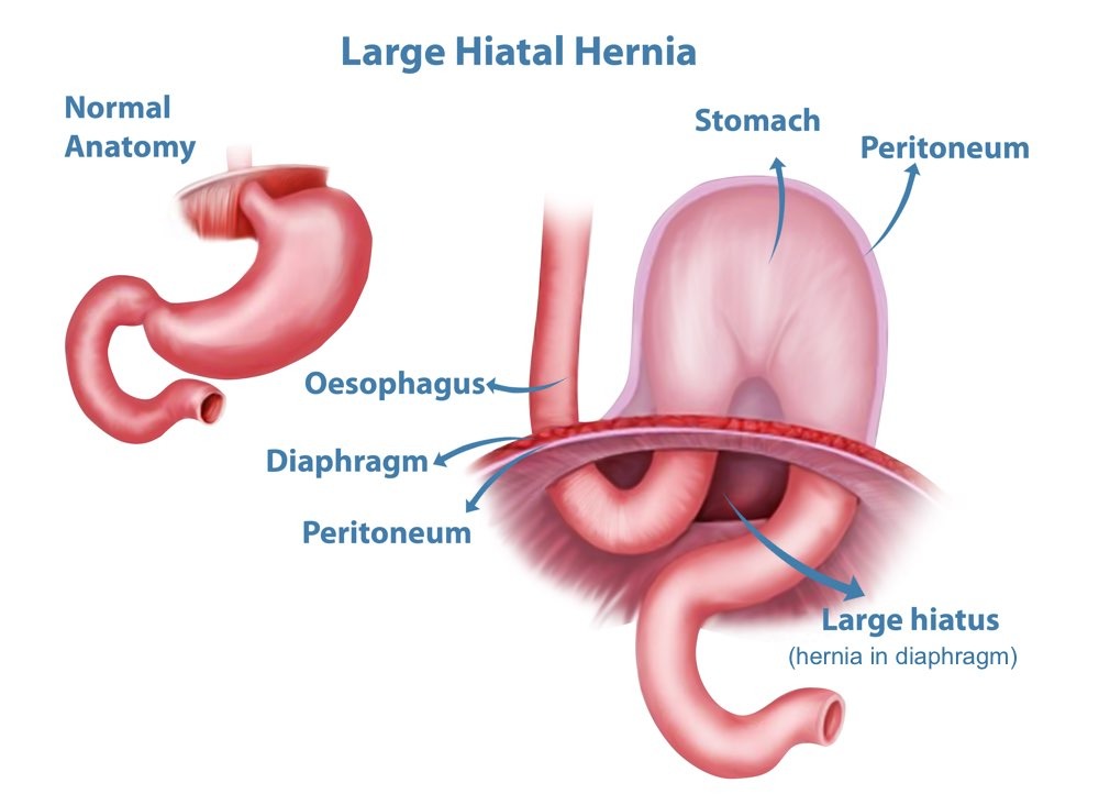 Understanding ICD-10 K44.9: A Comprehensive Guide to Diaphragmatic Hernia