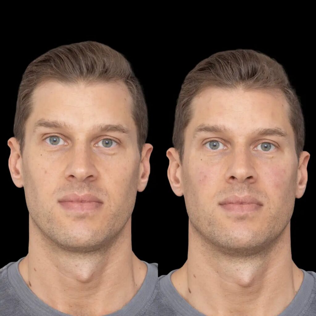 Jawline Fillers for Men: Insights from the Best Aesthetic Clinic in dubai