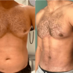 Best Gynecomastia Surgeon in Dubai