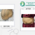 Tummy Tuck in Lahore