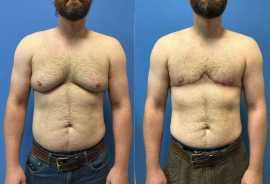 Gynecomastia Surgery Price in Lahore: A Comprehensive Guide