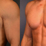 Gynecomastia Surgery in Lahore