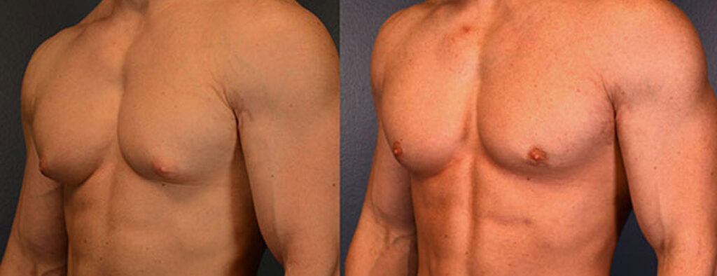 Gynecomastia Surgery in Lahore