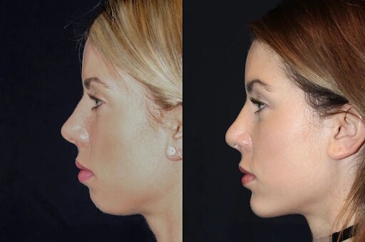 chin fillers in dubai