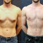 Gynecomastia Surgery in Dubai