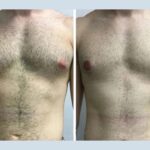 Best Gynecomastia Surgeons in Dubai