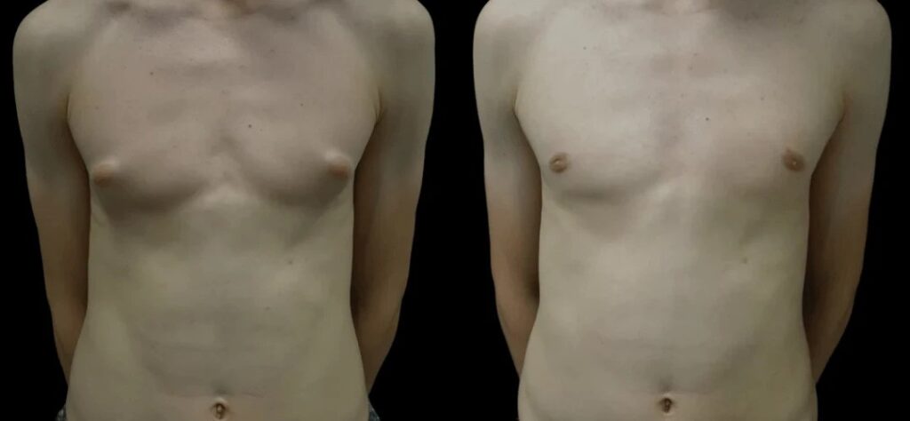 Gynecomastia Surgery in Dubai