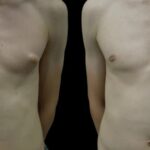 Gynecomastia Surgery in Dubai